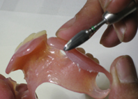 カーバイドバーで形状を整え、形態修正を行います。