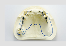 レスト作製・固定
