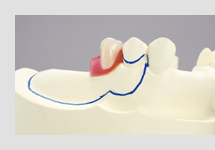 抜き方方法決定