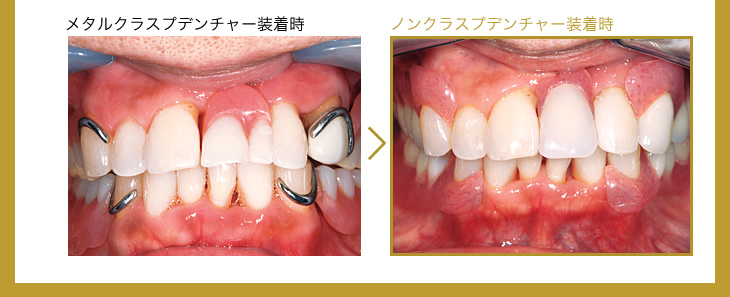 メタルクラスプデンチャー装着時イメージ、ノンクラスプデンチャー装着時イメージ比較