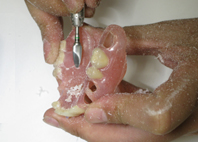 スプルー部分の形態修正