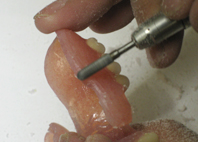 辺縁部分の形態修正