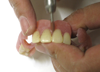 歯間部分の研磨