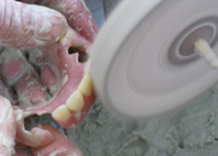 歯間部分の砂研磨