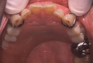 初診時の口腔内写真