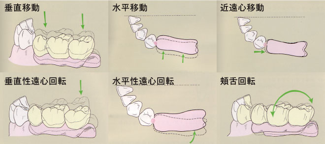 図1 義歯の動き