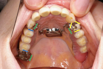 図3b 内側性把持と外側性把持
