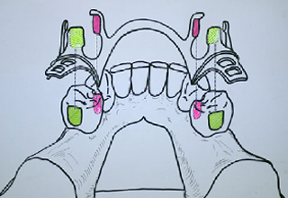 図4b 複数形成することにより義歯の動きを規制