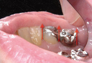 図4a 着脱方向に平行に形成することにより

義歯の着脱方向を規制