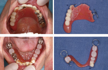 図5 破折を繰り返す義歯