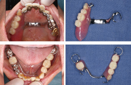 図6 義歯の設計原則に則って作製した義歯