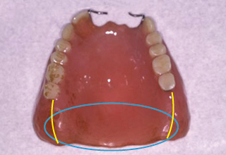 発音において問題のある義歯