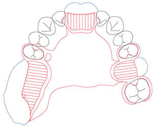 図５a　上顎右１６７. 左１６欠損、II級2類(Kennedyの分類)
