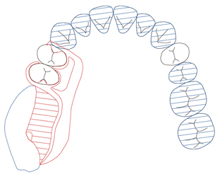 図５b　図5aをブリッジにより中間欠損を補綴することによりII級に変更