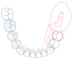 図６a　下顎右５. 左６７欠損、中間欠損をブリッジにすることにより下顎左６７の片側設計に変更
