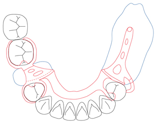 図６b　図６aと異なり中間欠損をブリッジで補綴しても両側設計になるため中間欠損も義歯に組み込む