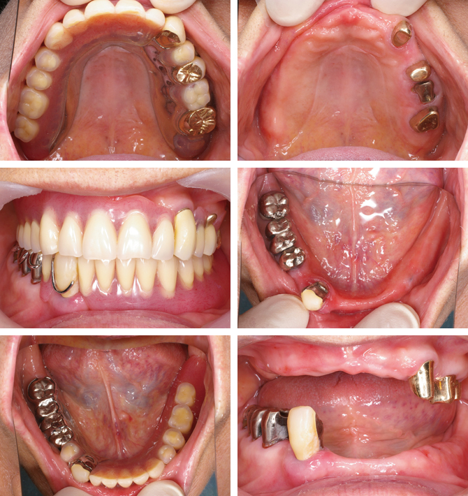 図2 上顎にコーヌステレスコープを選択した症例
