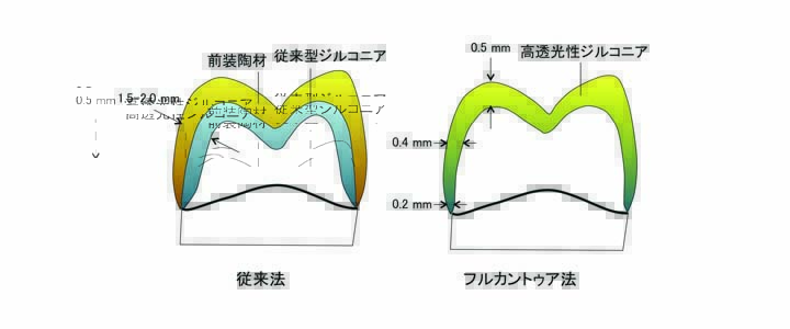 図4 歯冠外アタッチメント（mini-Dalbo）を用いた義歯