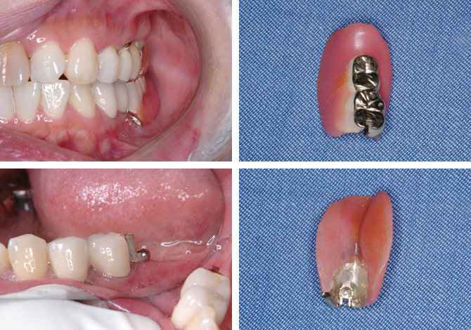 図4 歯冠外アタッチメント（mini-Dalbo）を用いた義歯