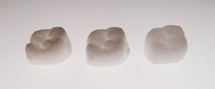 図4 歯冠外アタッチメント（mini-Dalbo）を用いた義歯