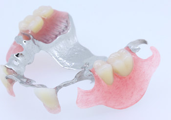 図4 歯冠外アタッチメント（mini-Dalbo）を用いた義歯